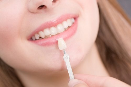 Porcelain Veneers - restorative dental adelaide