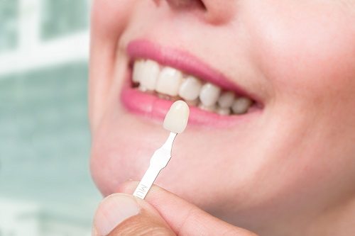 Veneers for dental