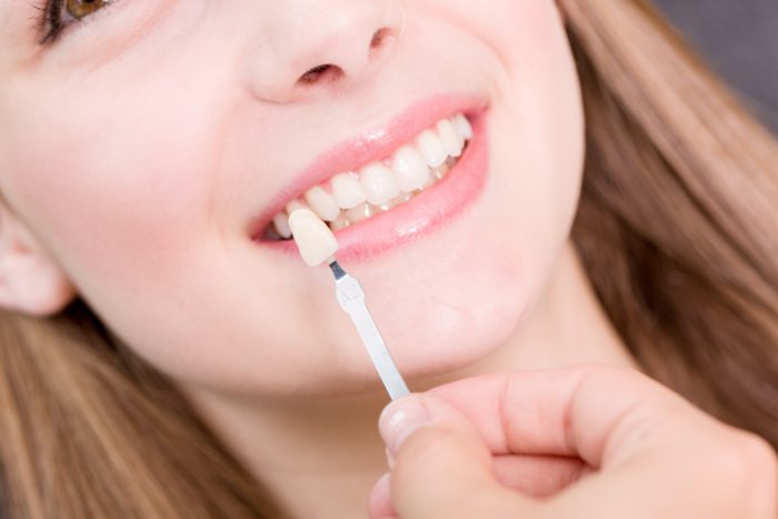 Veneers - restorative dentist adelaide